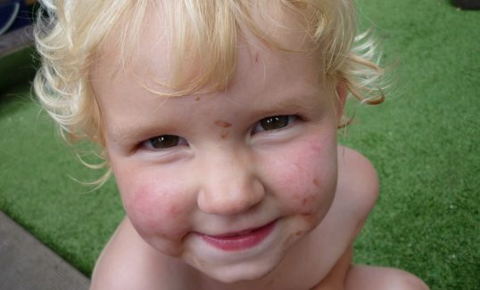 autyzm dziecięcy rokowania